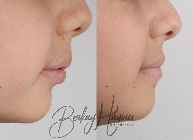 Çocuklarda Çene Geriliği