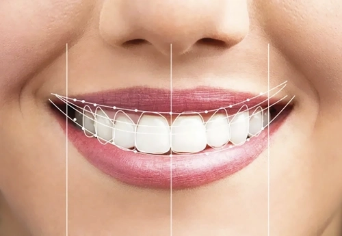 Dijital Gülüş Tasarımı (Digital Smile Design - DSD)