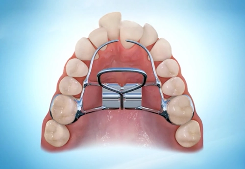 Çene Darlığı Aparatı (Üst Çene Genişletme Apareyi)