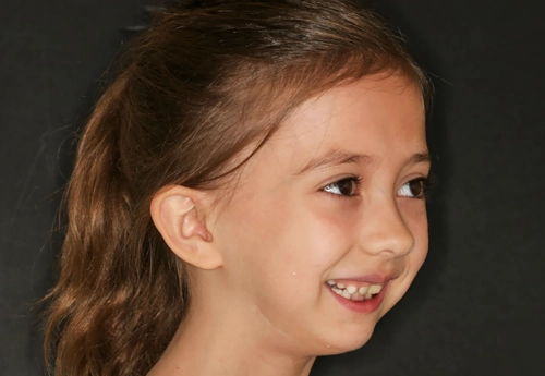 Çocuklarda Çene Darlığı Tedavisi