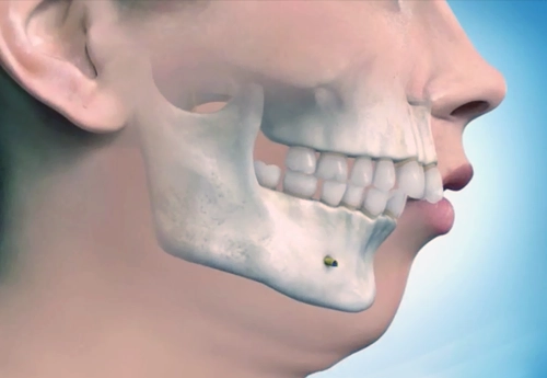 Çocuklarda Çene Geriliği Tedavisi