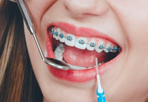 Diş Teli Tedavisi Ankara