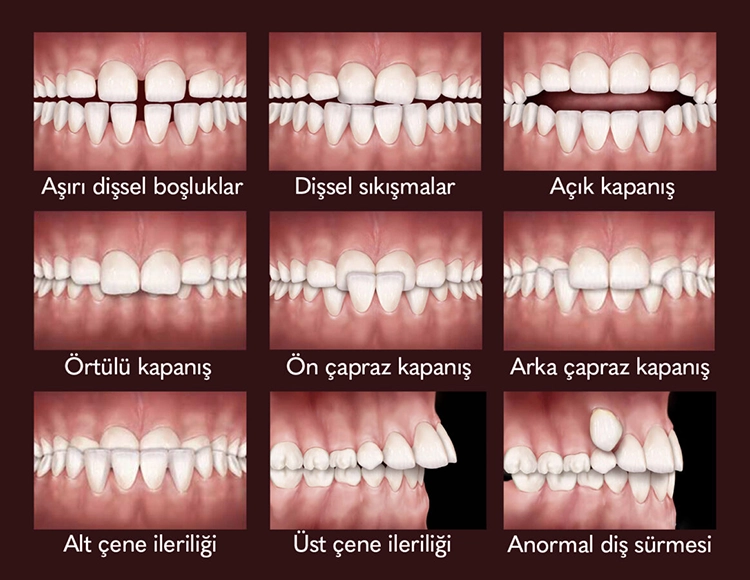 Şeffaf Plak Tedavisi Çeneyi Düzeltir Mi?