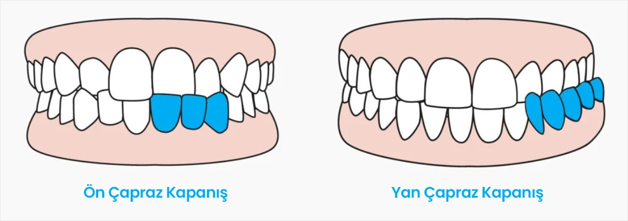 Çene Kapanış Şeffaf Plak