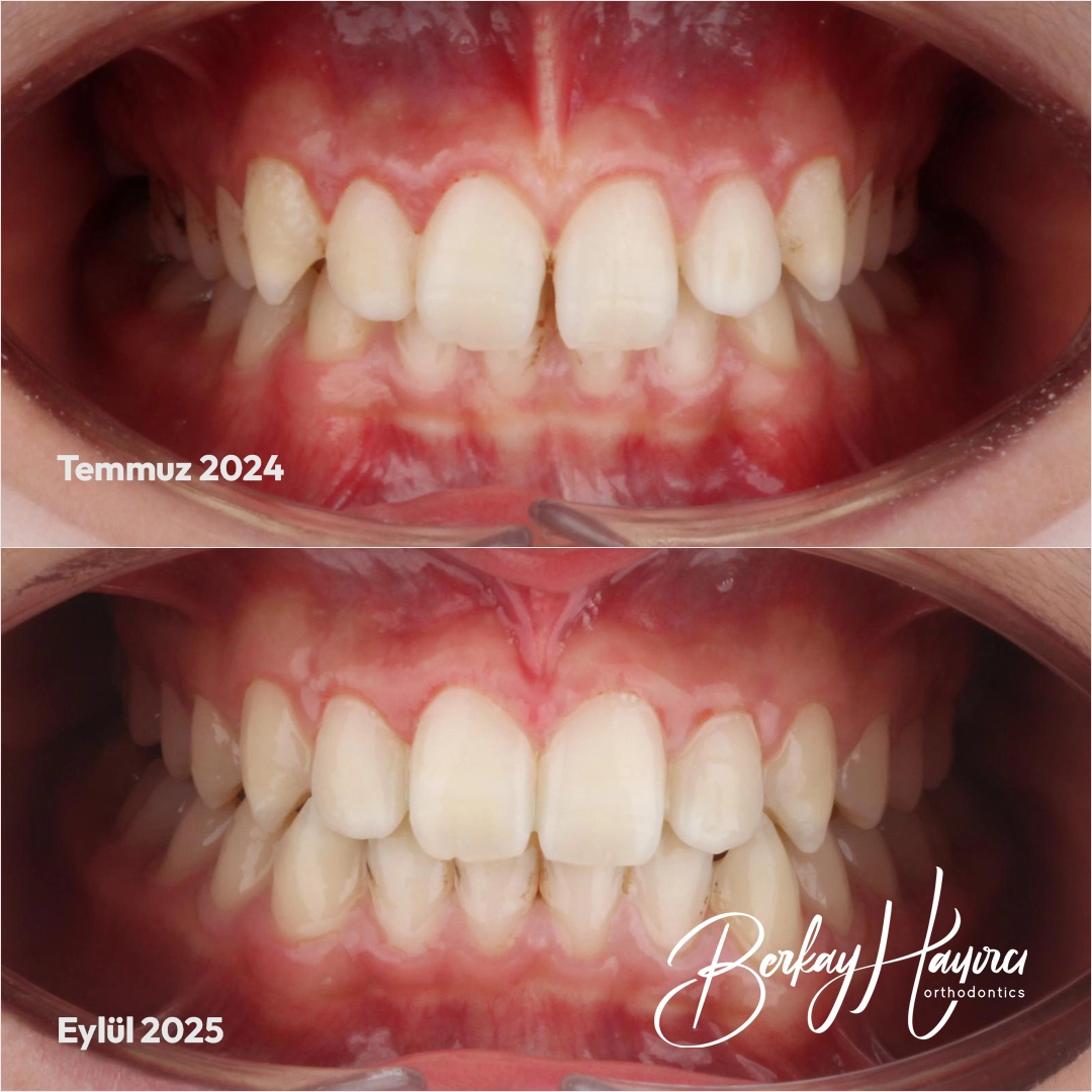 Şeffaf Plak Tedavisi (Invisalign) Öncesi Sonrası